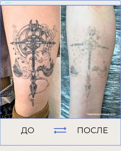 Удаление татуировки